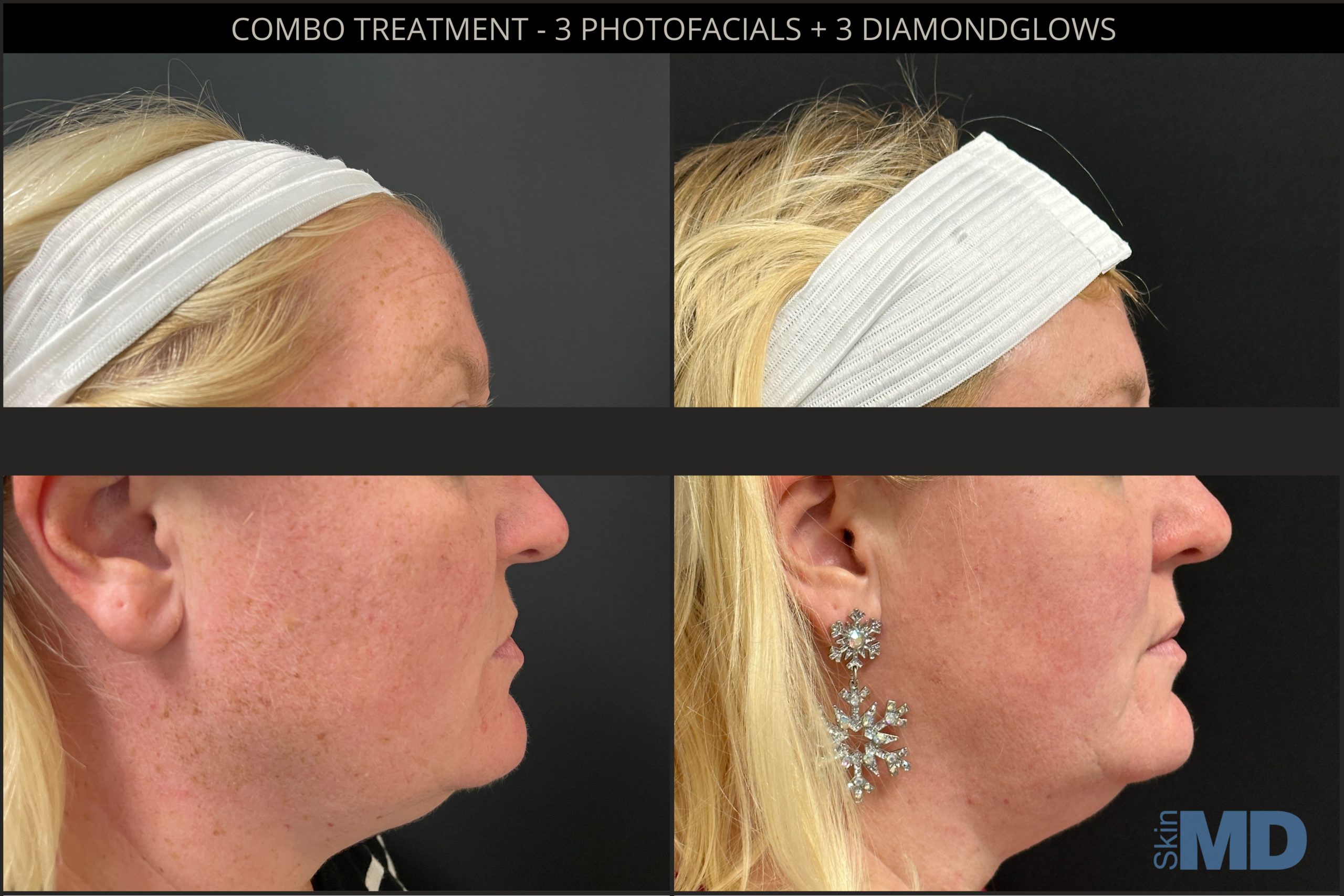 Before and after Combo treatment results