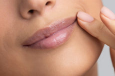 Dermal Fillers