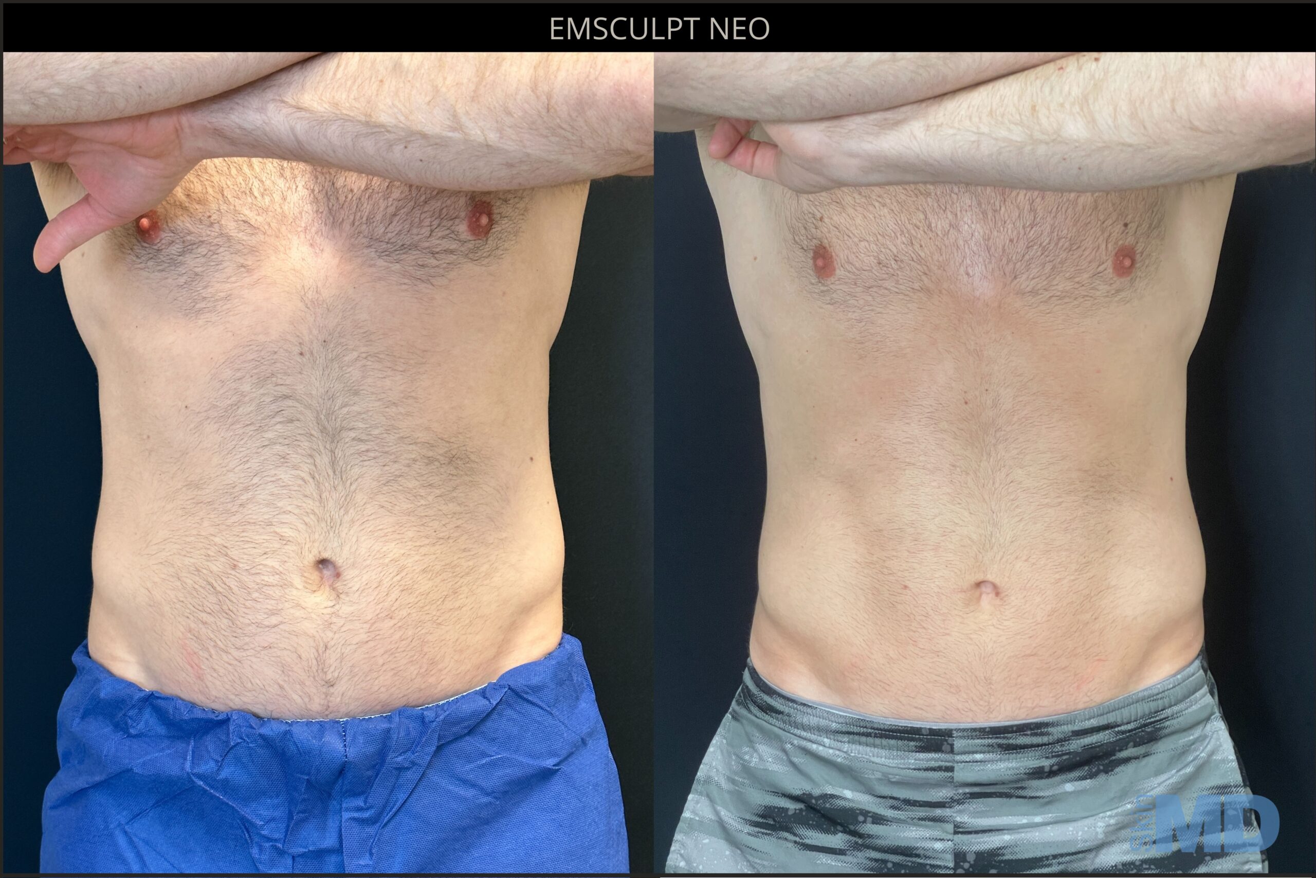 Before and after Emsculpt NEO results