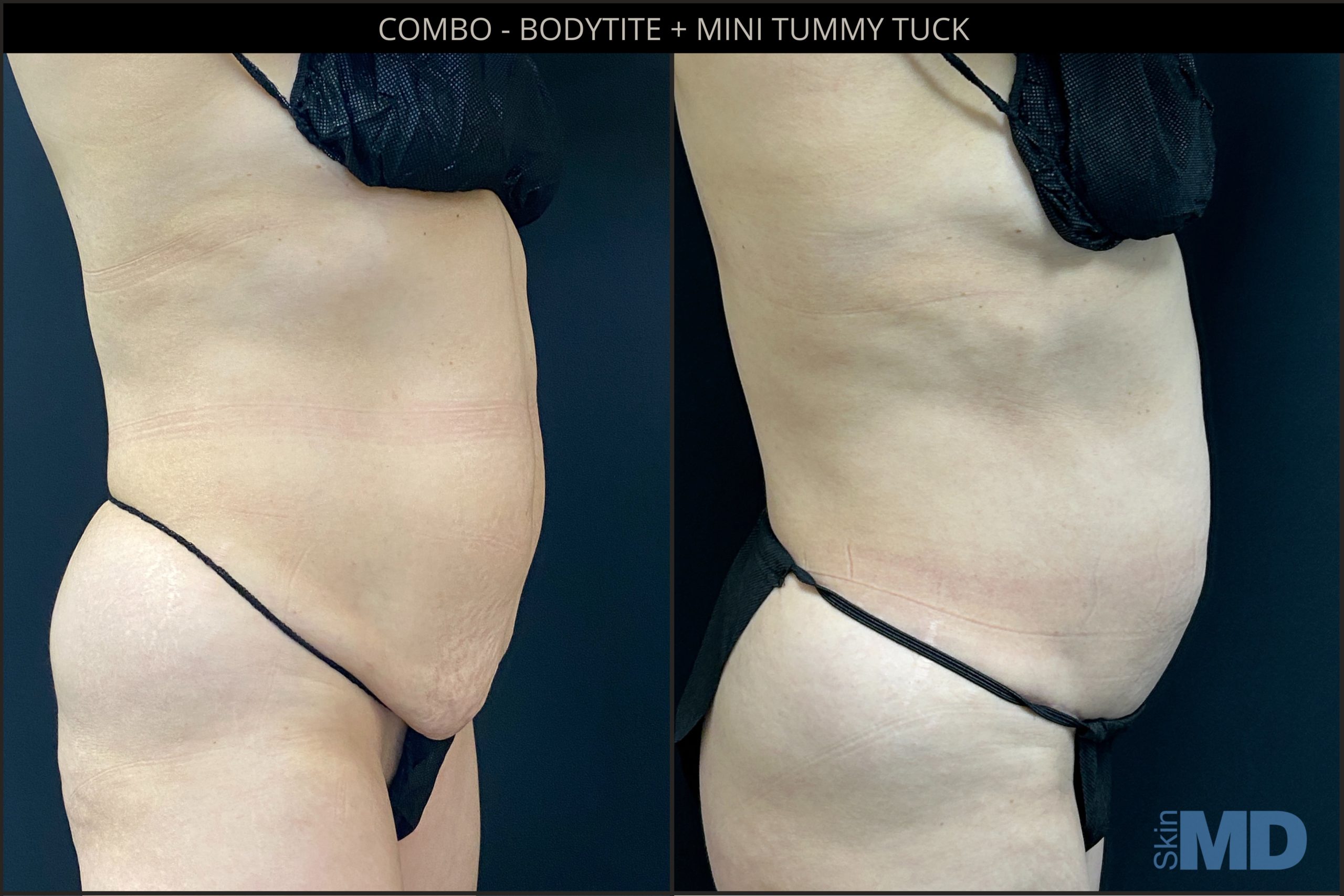 Before and after combo Bodytite and tummy tuck treatments