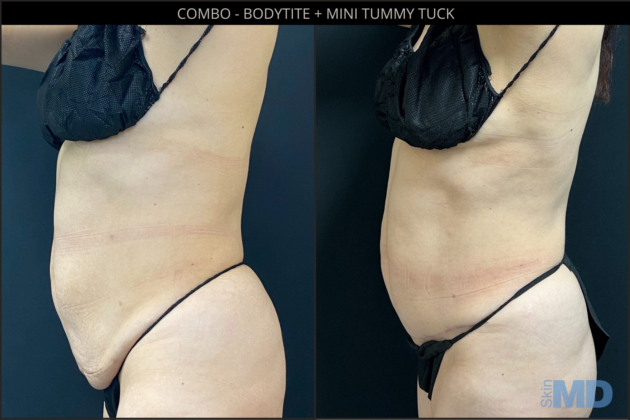 Before and after combo Bodytite and tummy tuck treatments