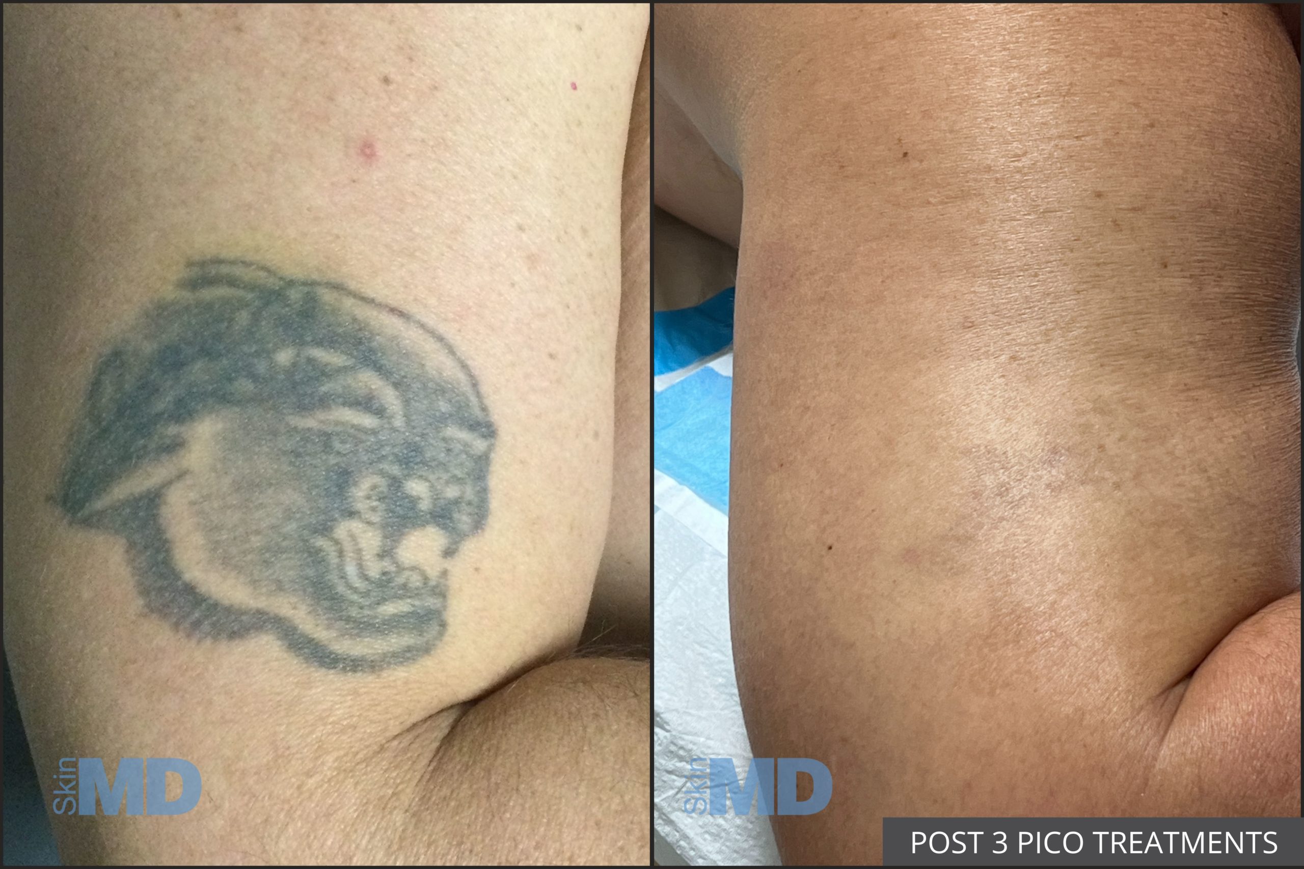 Before and after tattoo removal results