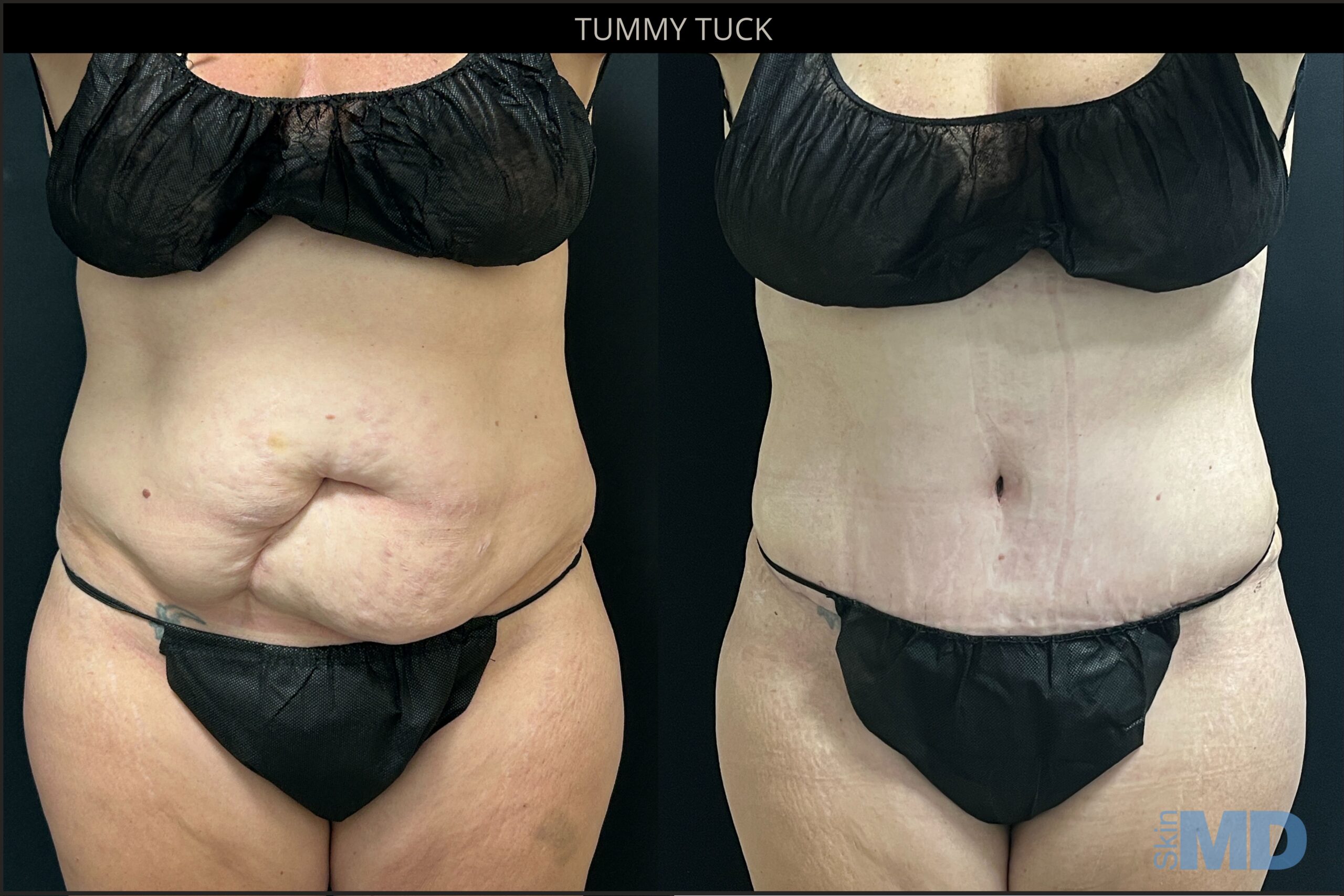 Before and after tummy tuck results