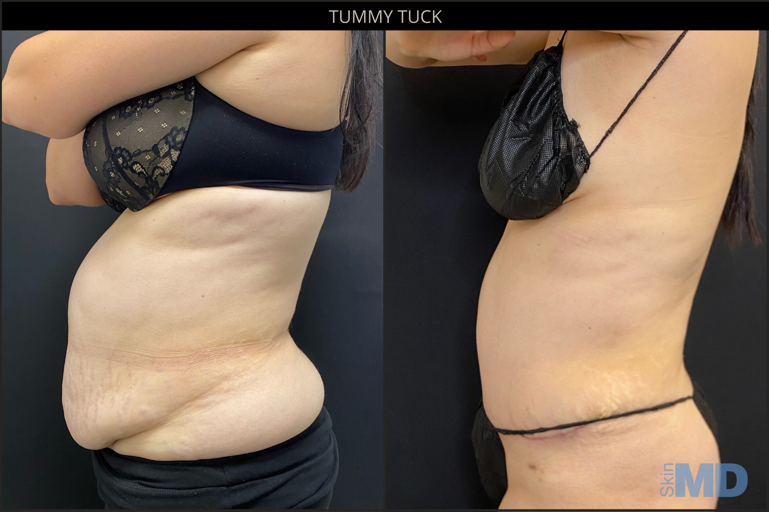 Before and after Tummy Tuck results