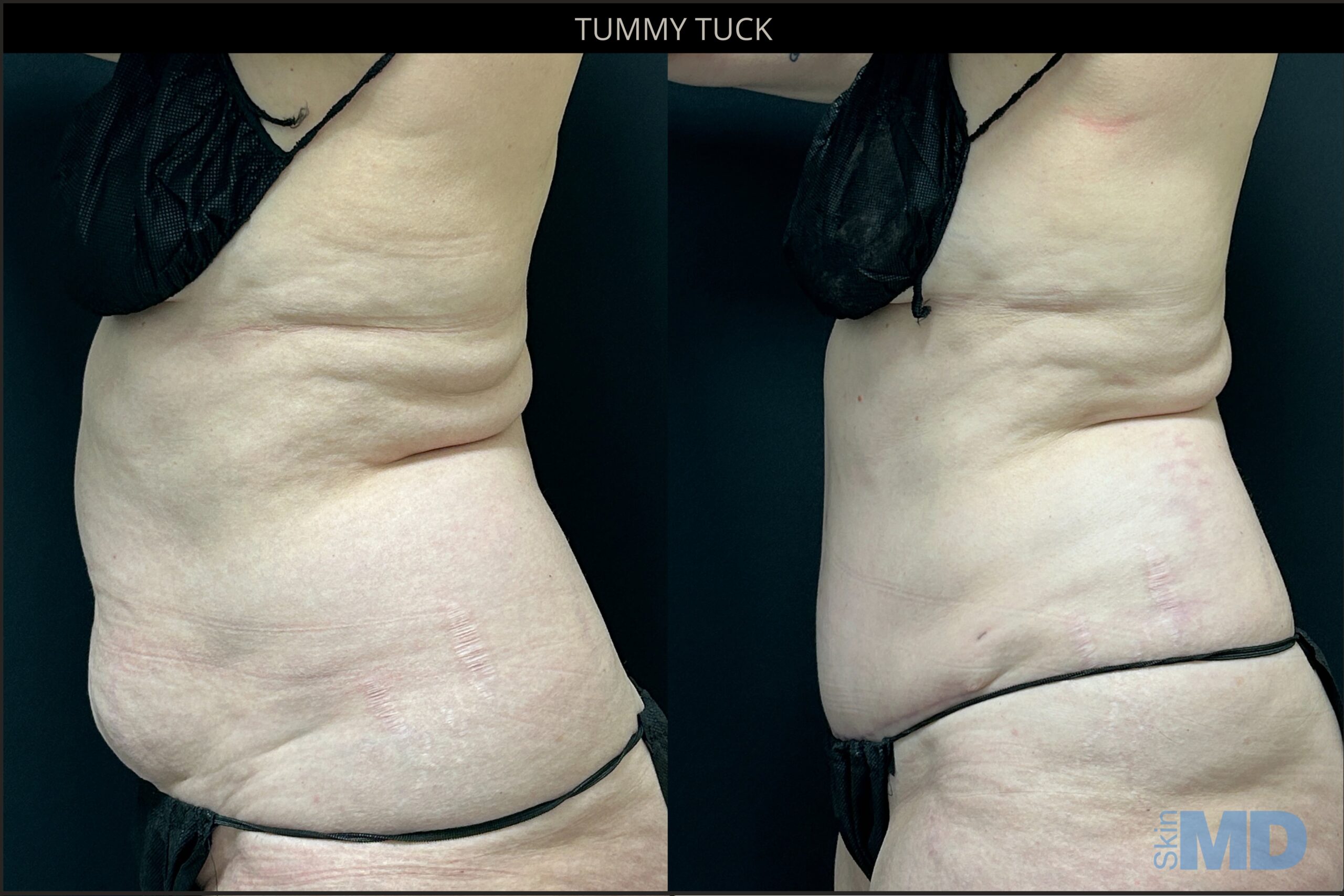 Before and after tummy tuck results