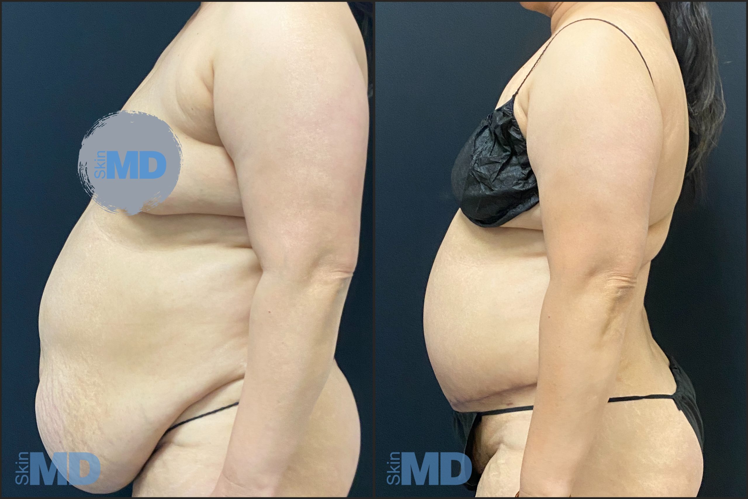 Before and after Tummy Tuck results