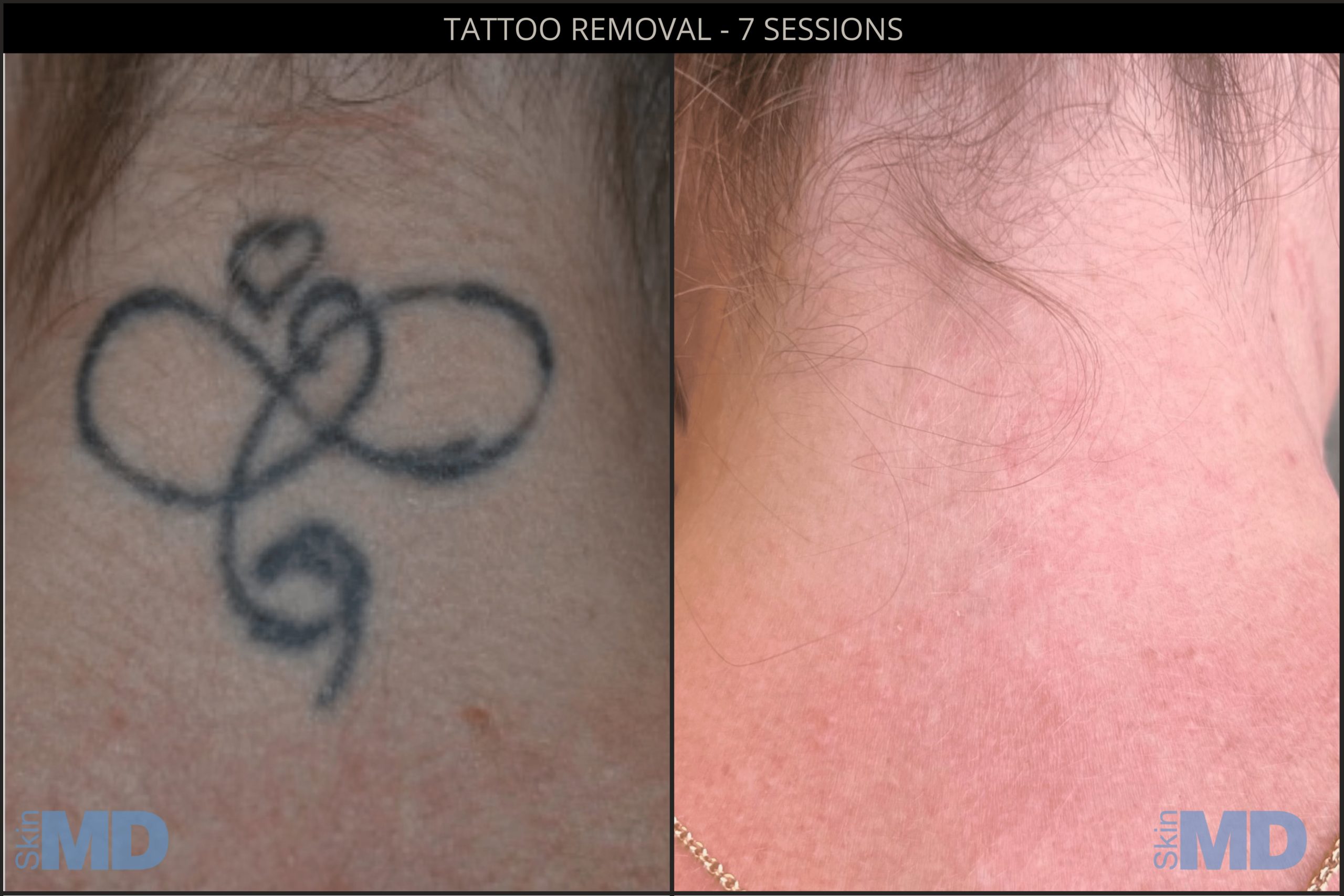 Before and after tattoo removal results