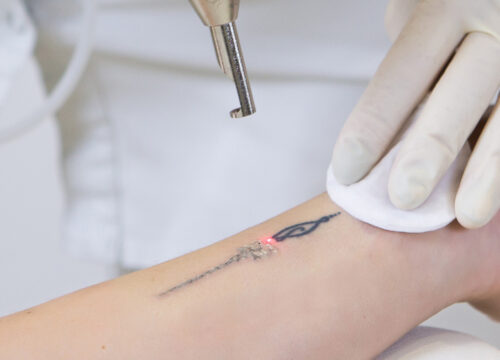 Tattoo Removal Promotion