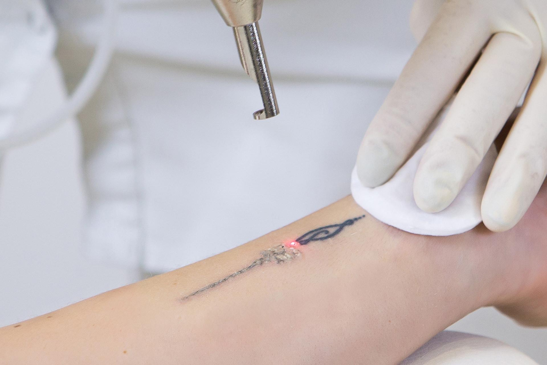 Tattoo Removal – 30% Off