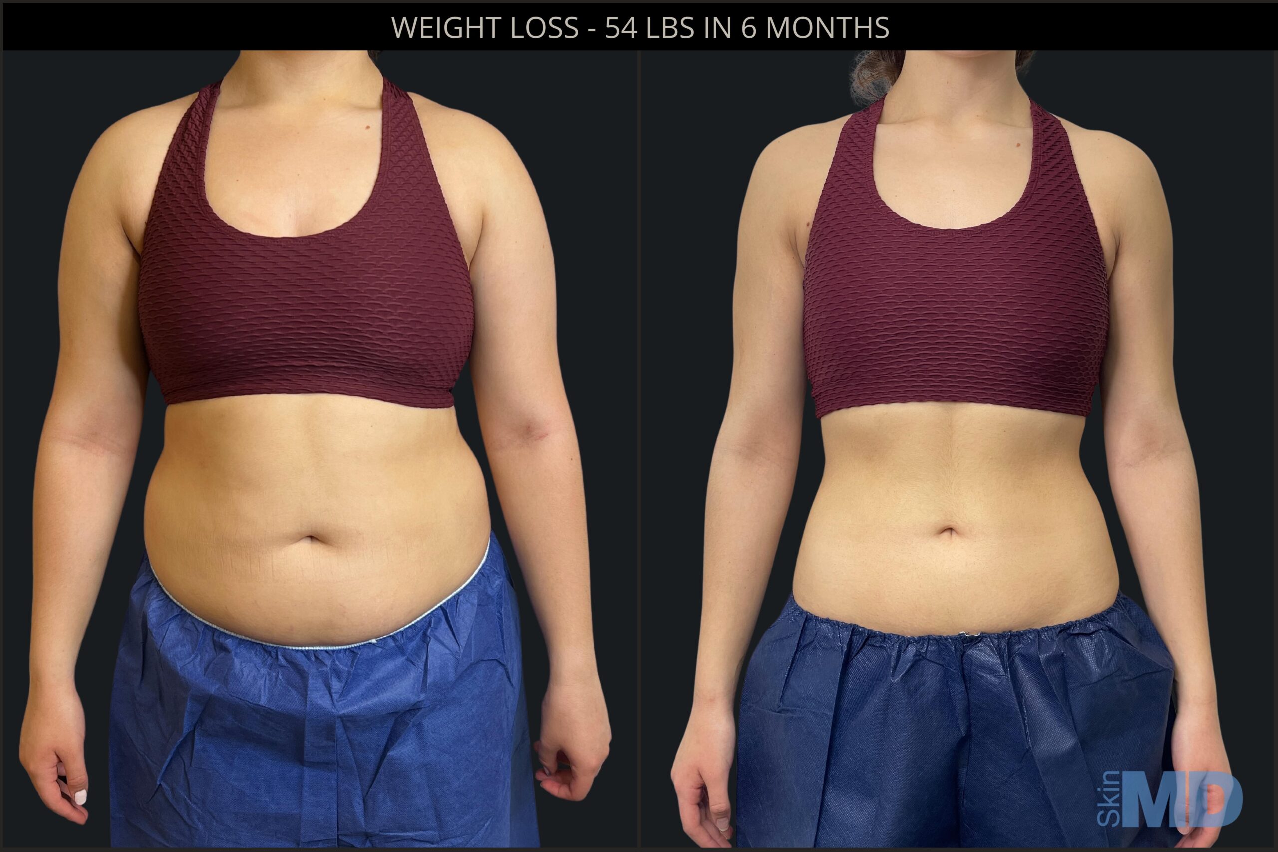 Weight Loss Before & After  Skin MD Laser & Cosmetic Group
