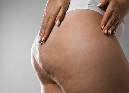 Cellulite Treatment