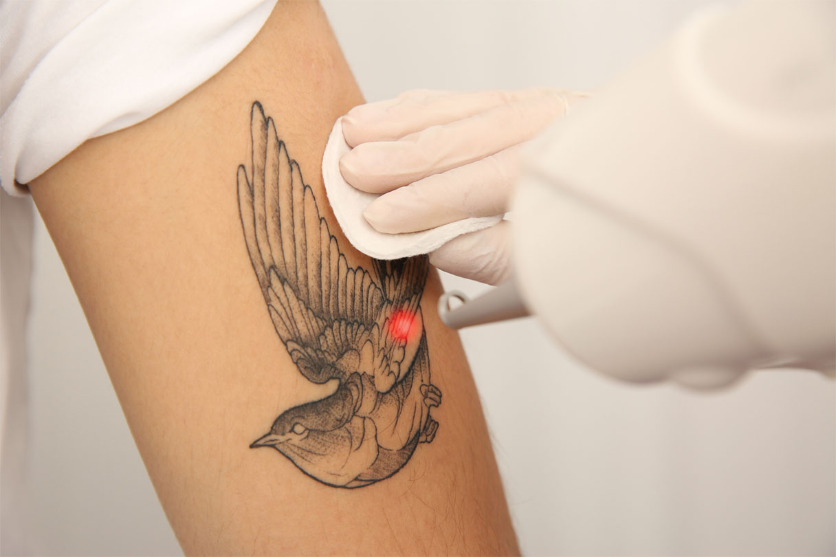Faded by Summer – 20% Off Tattoo Removal