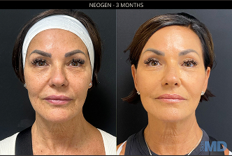 Face Tite Combined Image