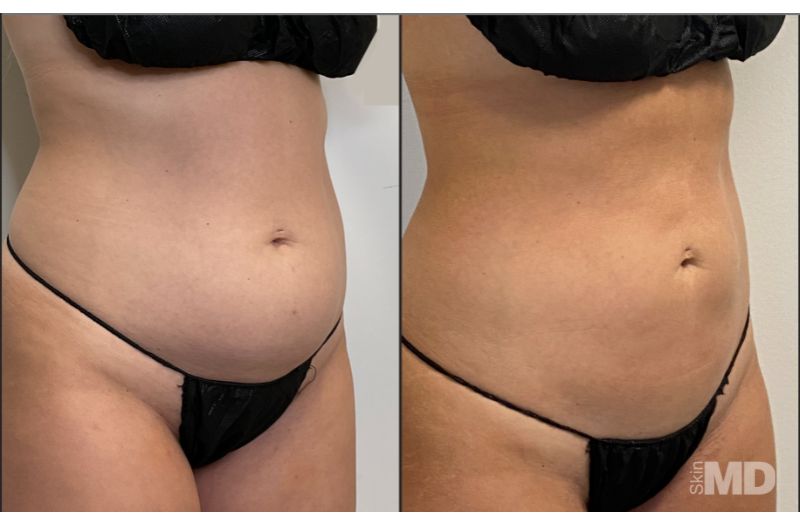 BodyTite Liposuction #8