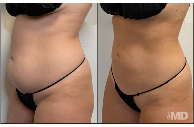 BodyTite Liposuction #9