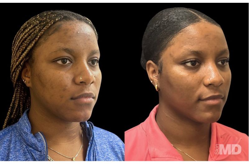 1540 Fractional Resurfacing #1