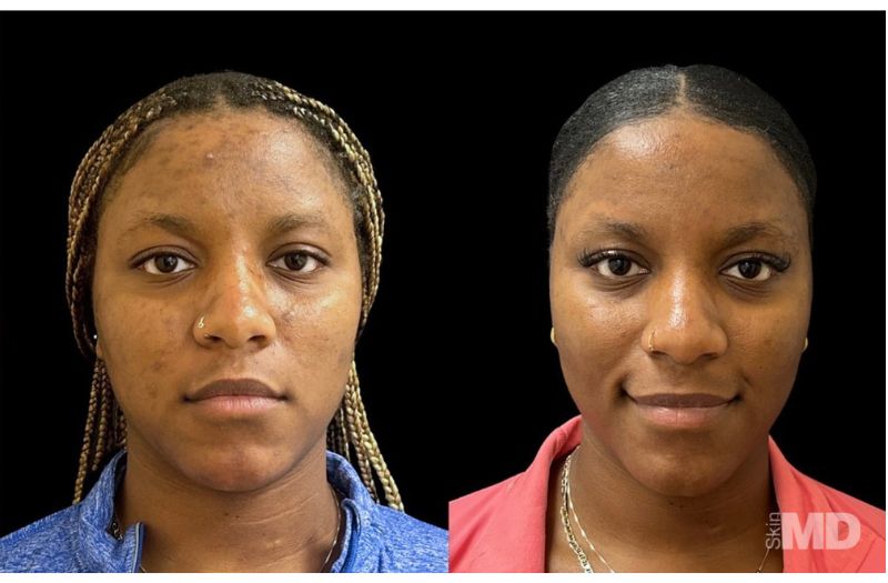 1540 Fractional Resurfacing #2