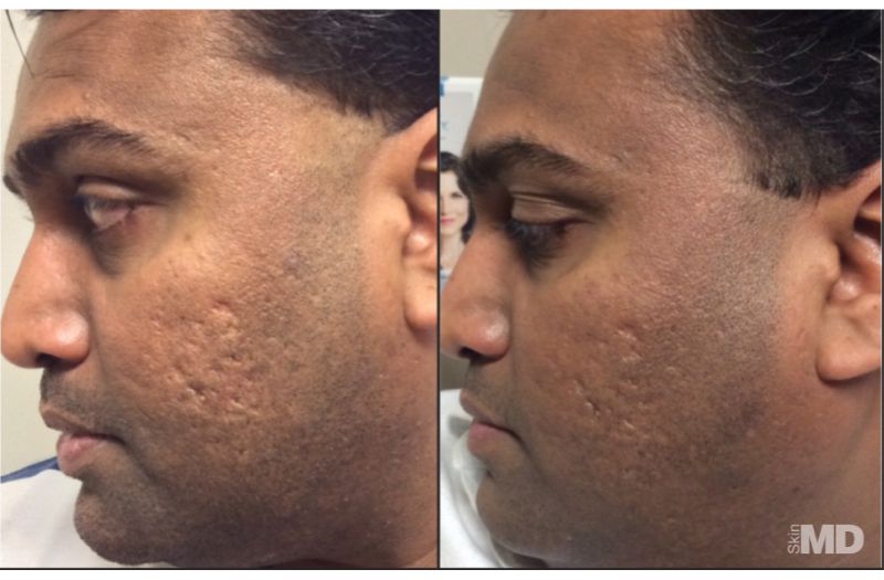 1540 Fractional Resurfacing #3