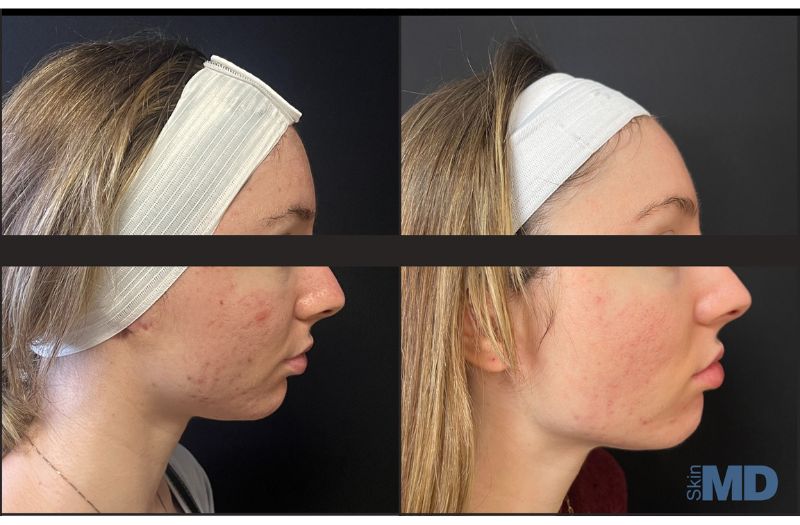 1540 Fractional Resurfacing #5