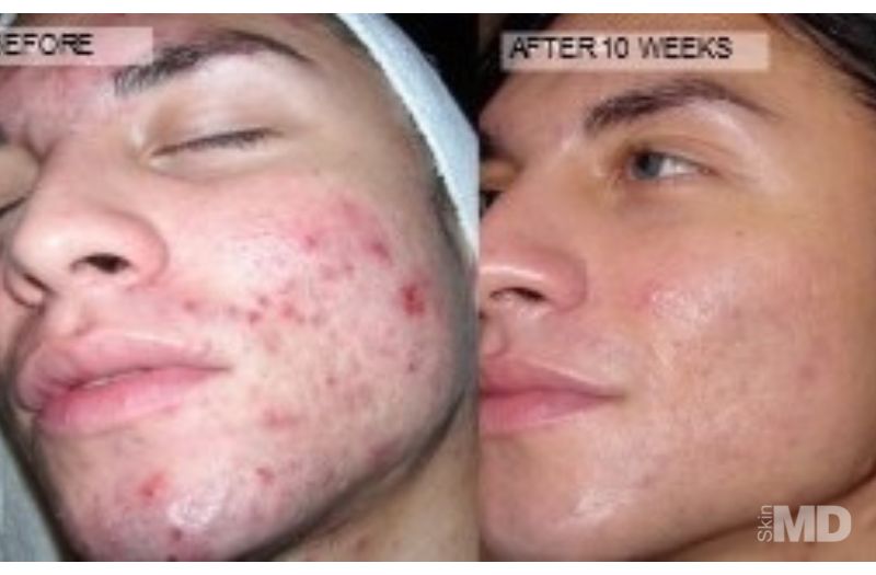 DiamondGlow™ Facial #2