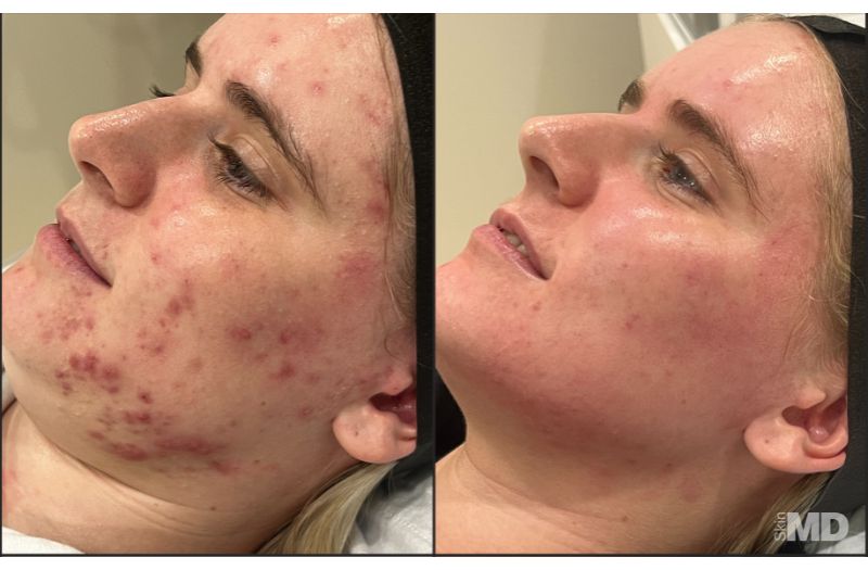 DiamondGlow™ Facial #1