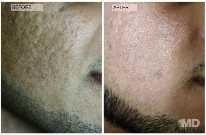 CO2RE® Laser Resurfacing #3