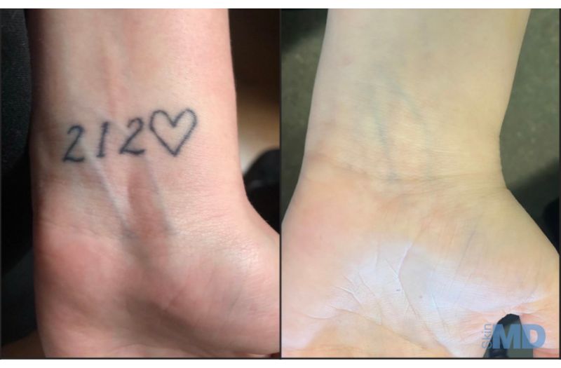 Tattoo Removal #2