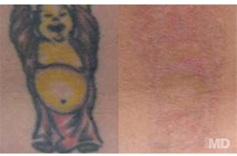 Tattoo Removal #3