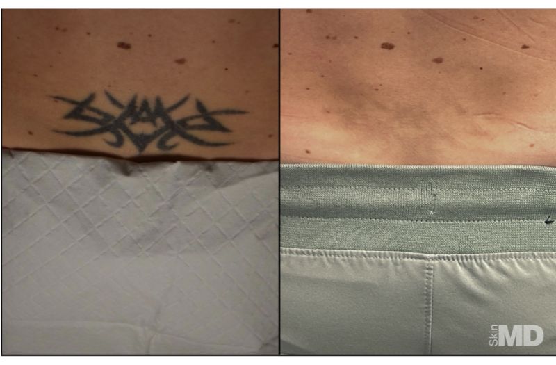 Tattoo Removal #5
