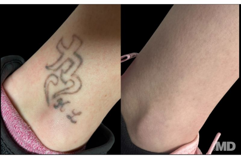 Tattoo Removal #6