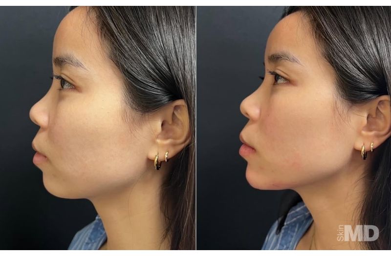 Dermal Filler – Non-Surgical Nose #1