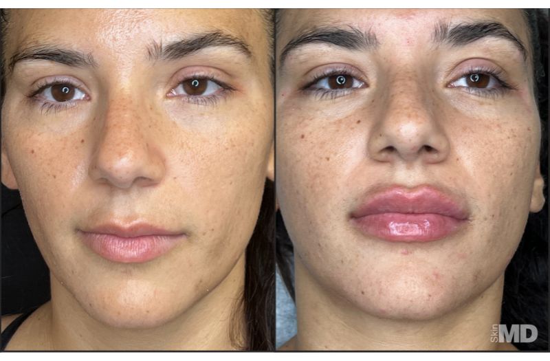 Dermal Filler – Non-Surgical Nose #2