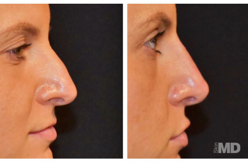 Dermal Filler – Non-Surgical Nose #3