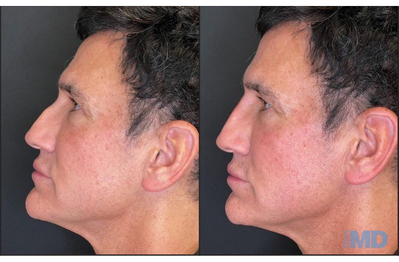 Dermal Filler – Non-Surgical Nose #4