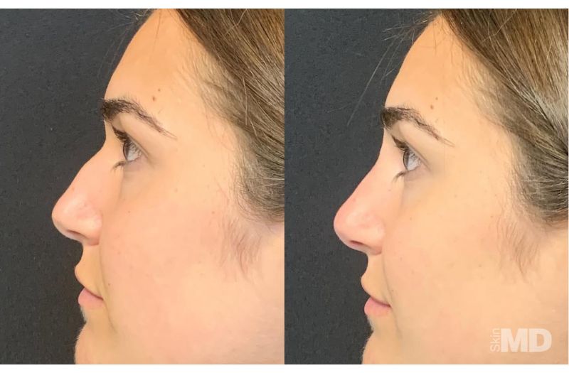 Dermal Filler – Non-Surgical Nose #5