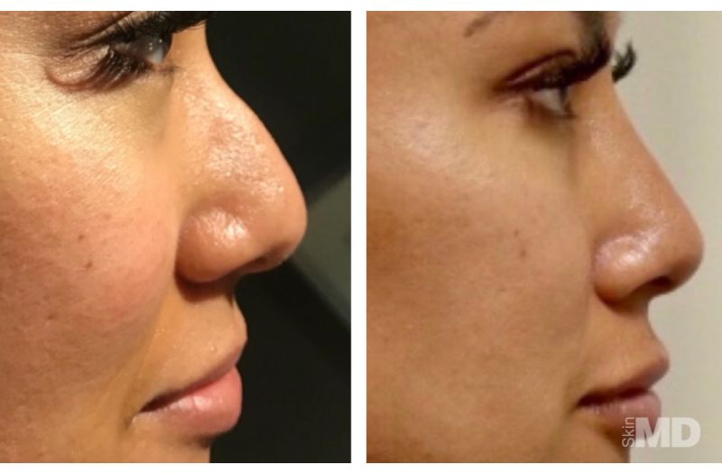 Dermal Filler – Non-Surgical Nose #6