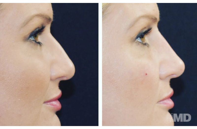 Dermal Filler – Non-Surgical Nose #7