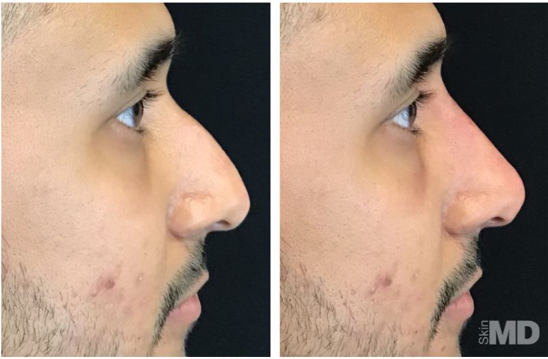 Dermal Filler – Non-Surgical Nose #8