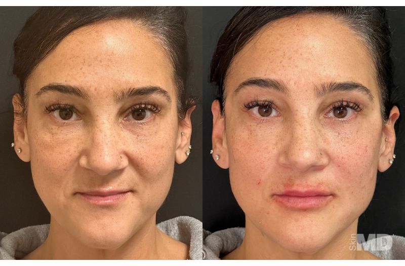 Dermal Filler – Lips #1