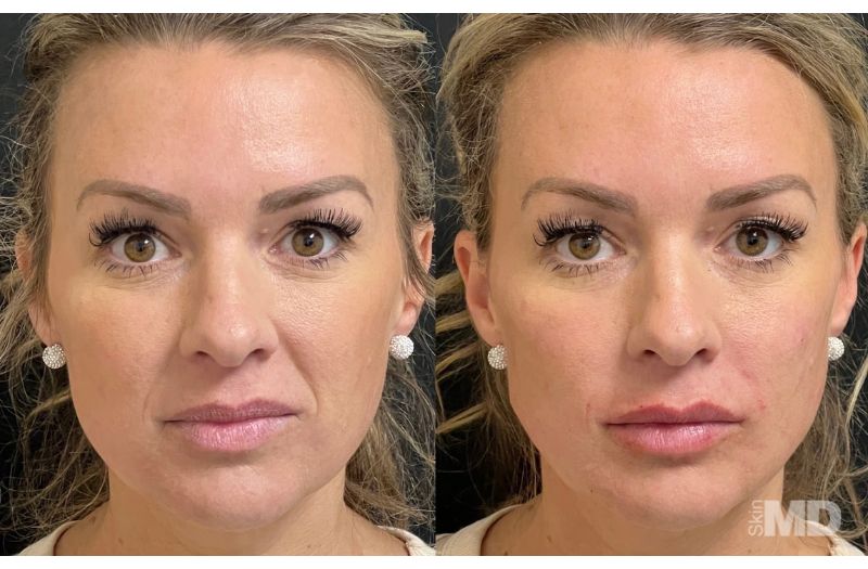 Dermal Filler – Lips #2