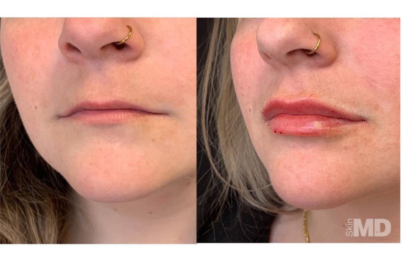Dermal Filler – Lips #4