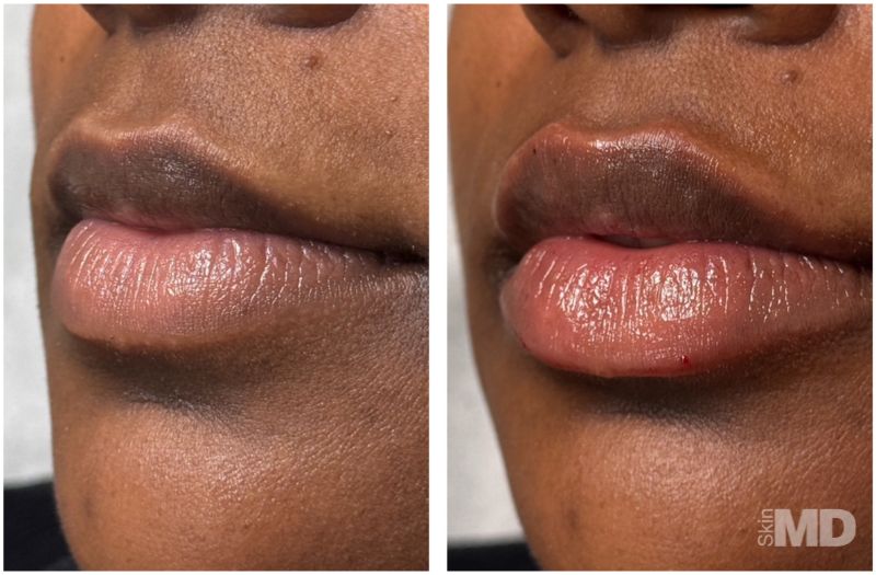 Dermal Filler – Lips #6