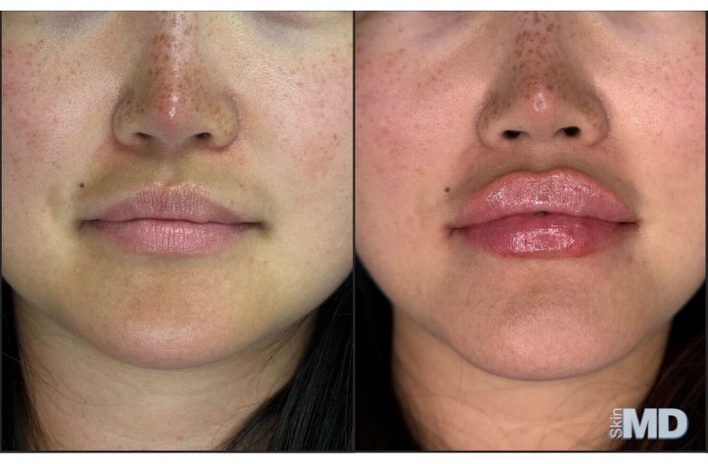 Dermal Filler – Lips #8