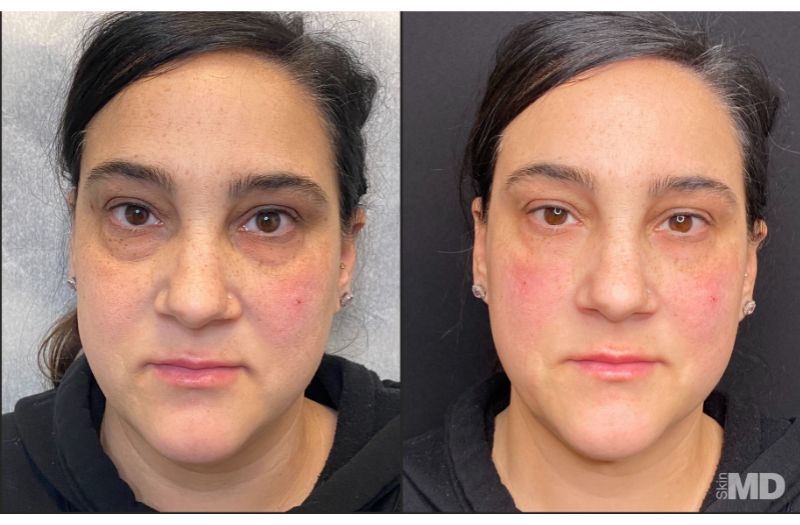 Dermal Filler – Under Eyes #1