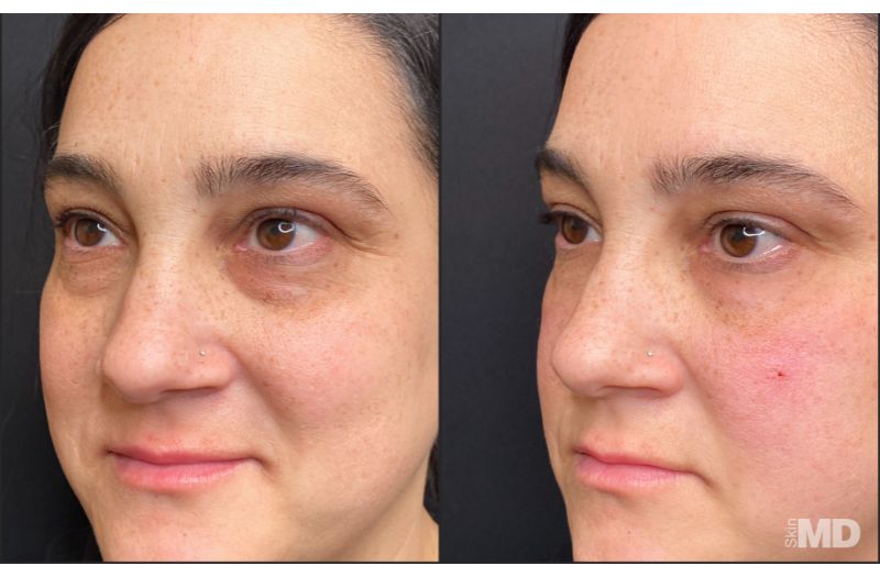 Dermal Filler – Under Eyes #2
