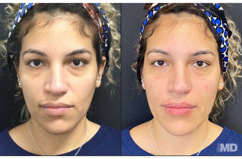 Dermal Filler – Under Eyes #3