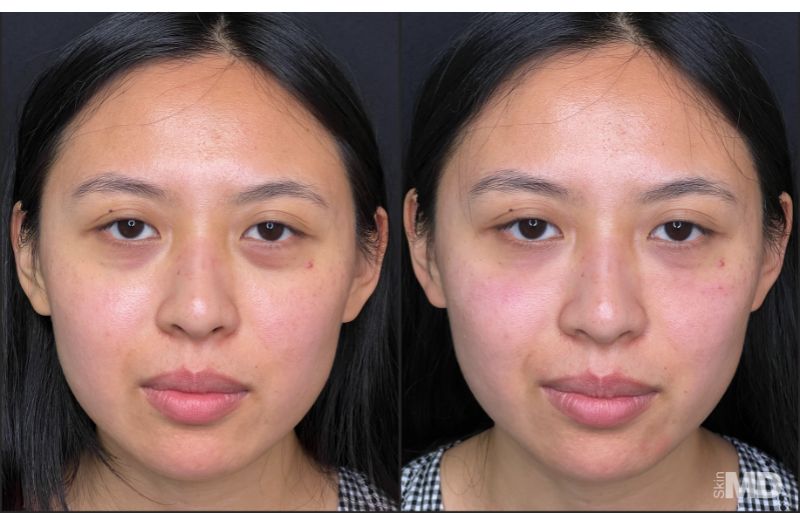 Dermal Filler – Under Eyes #4