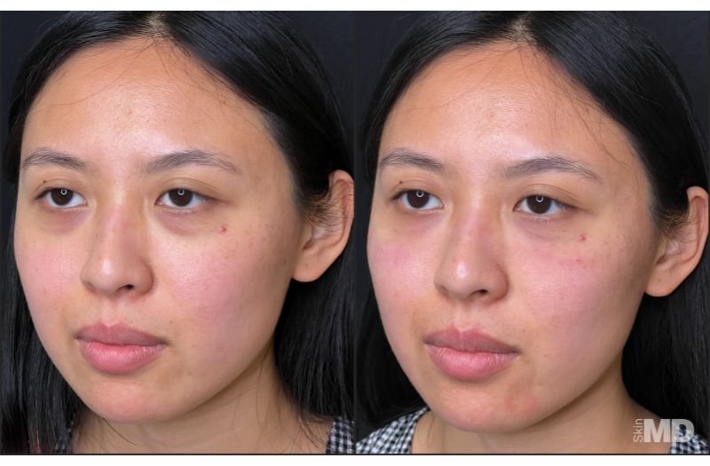 Dermal Filler – Under Eyes #5