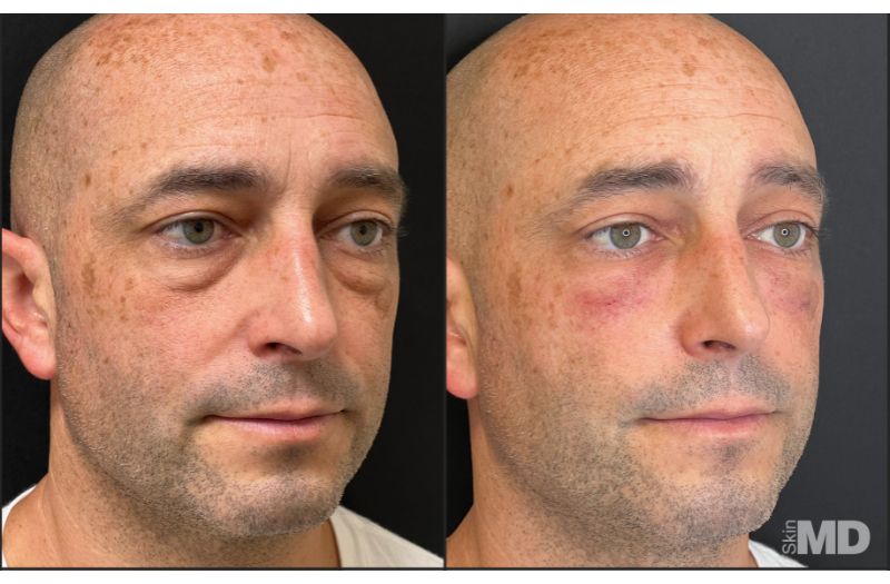 Dermal Filler – Under Eyes #7