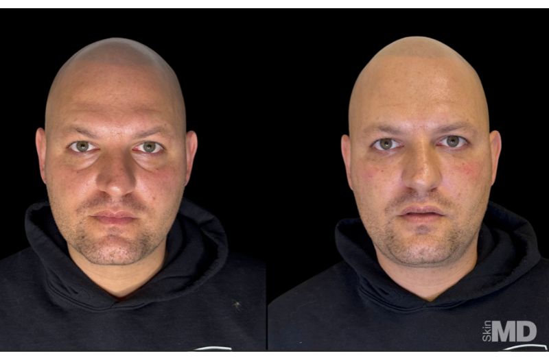 Dermal Filler – Under Eyes #8